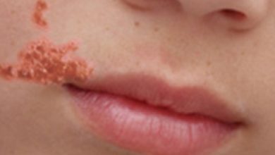 OBSECT DISEASE: Symptoms, Causes and Treatment