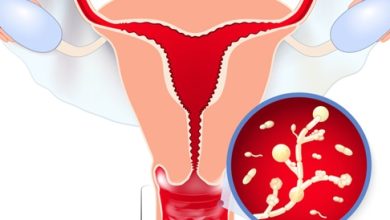 Vaginal candida disease: symptoms, causes and treatment
