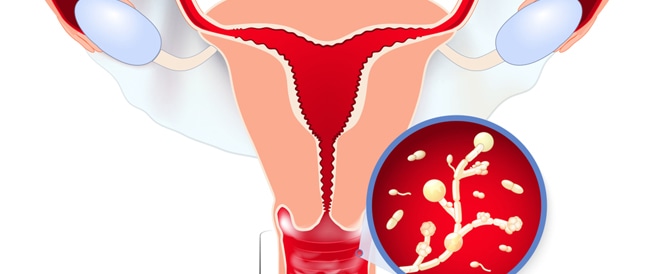 Vaginal candida disease: symptoms, causes and treatment