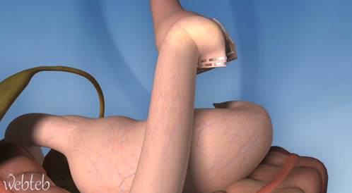 Transform the stomach stomach on a Roux-Ey way