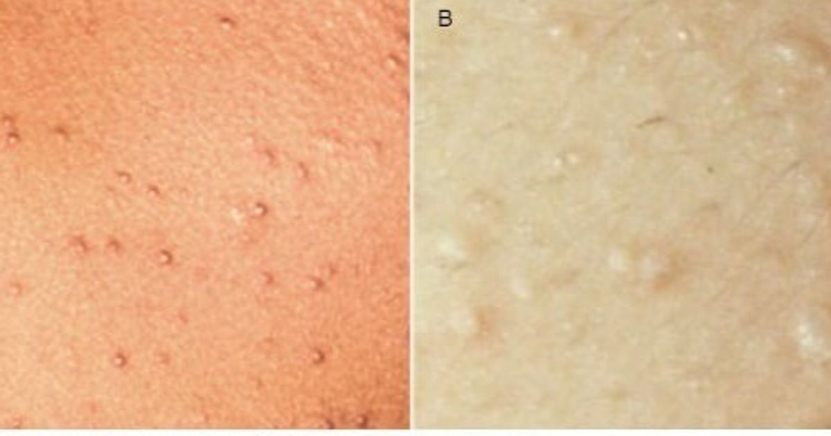 Chronic rash … annoying spots that can hinder daily life