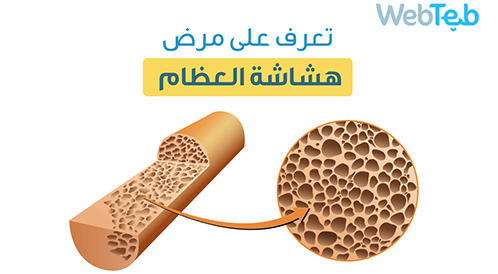 Watch the video: Osteoporosis