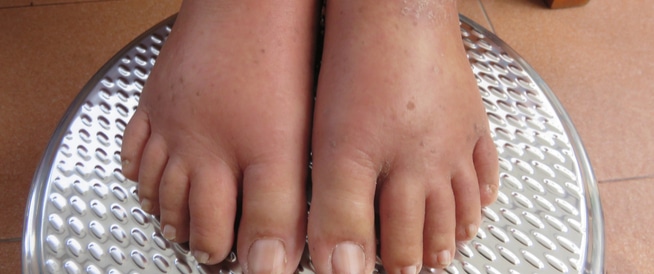 Edema: Causes, symptoms and treatment