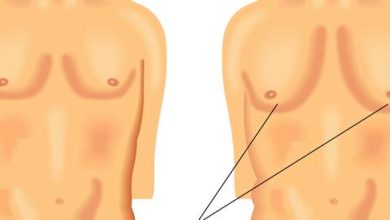 Gynecology in men: causes, symptoms and treatment