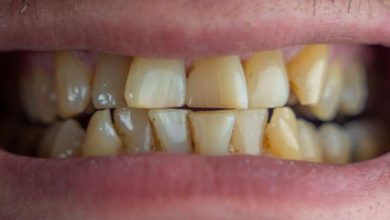 Which vitamin deficiency causes teeth to deteriorate?