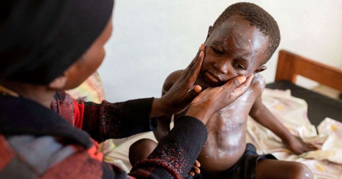 Monkey -water pox .. Uganda confirms the monitoring of two new injuries