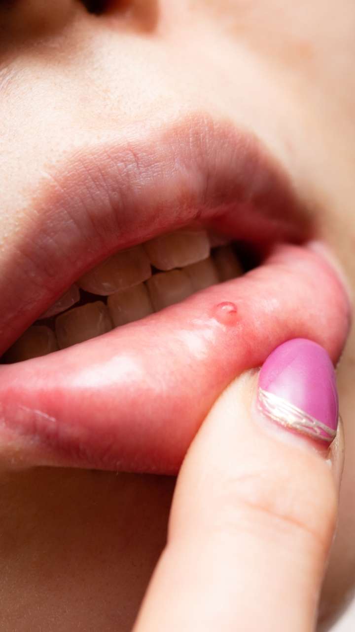 How to get rid of mouthwees overnight?