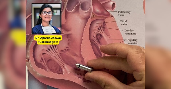 How Smaller Wireless Pacemakers Transforming Cardiac Care Heart Surgery Dr Aparna Jaswal