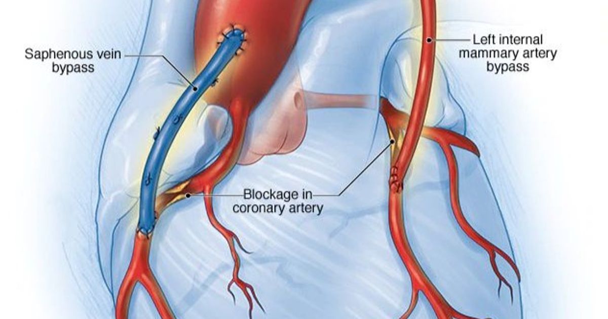Sudden heart stop … a disorder that can lead to death