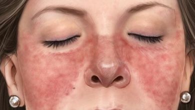 Lupus .. A self -immune disease is difficult to diagnose and treat