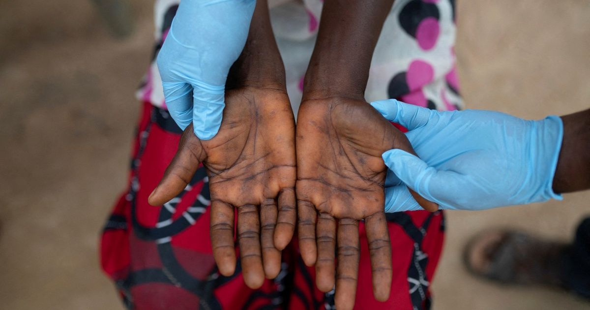 “World Health” asks for urgent action against “monkey frogs” in Africa