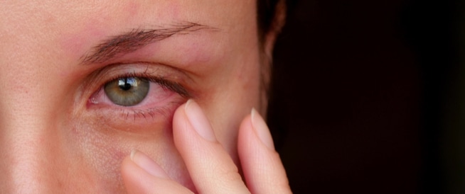 Eye inflammation: Causes, symptoms and treatment