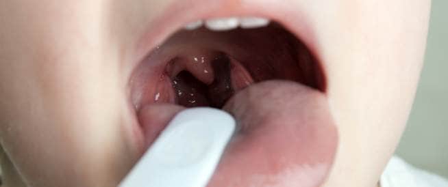 Sore throat: Causes, symptoms and treatment
