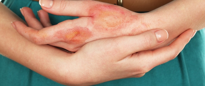 Burns: Causes, Symptoms and Treatment