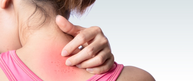 Skin Rash: Symptoms, Causes and Treatment
