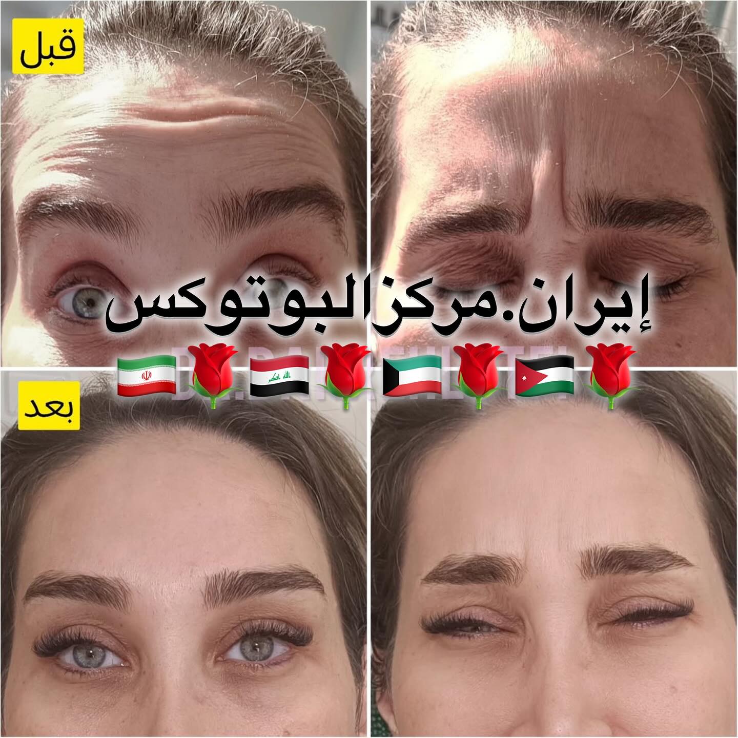 بوتوکس ایران #الجمال #المكياج #التجميل #السياحة_العلاجية #السياحة_في_إيران #إير… – ryan