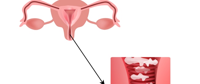 Vaginal infections: symptoms, causes and treatment