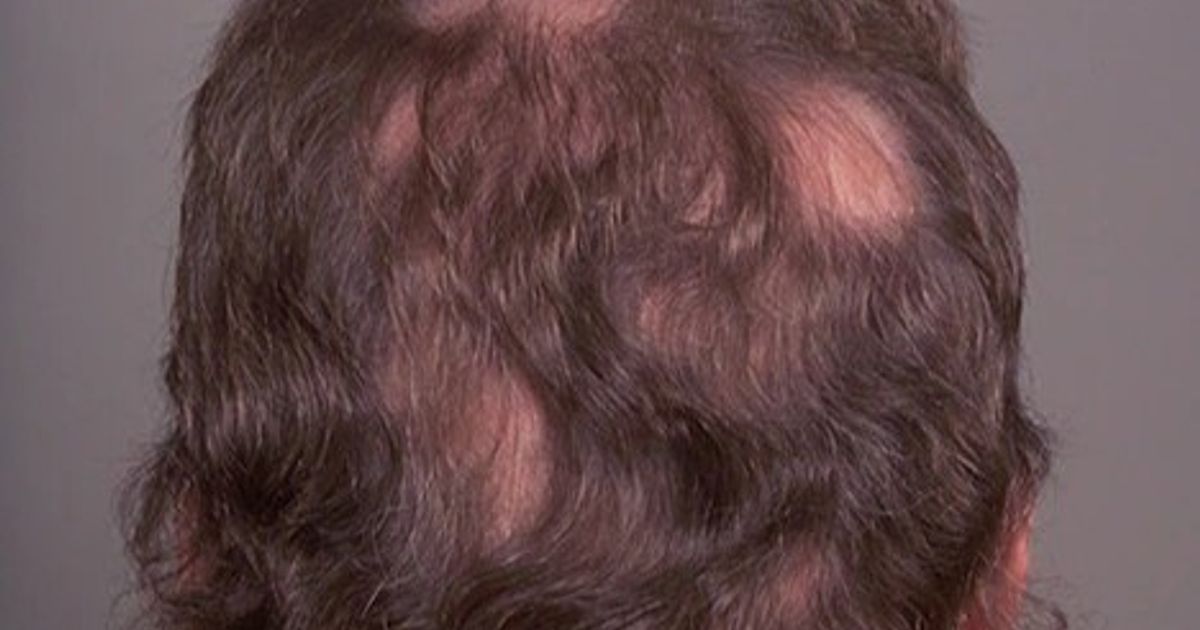 Hair loss .. Men and Women Guide for Treatment and Prevention