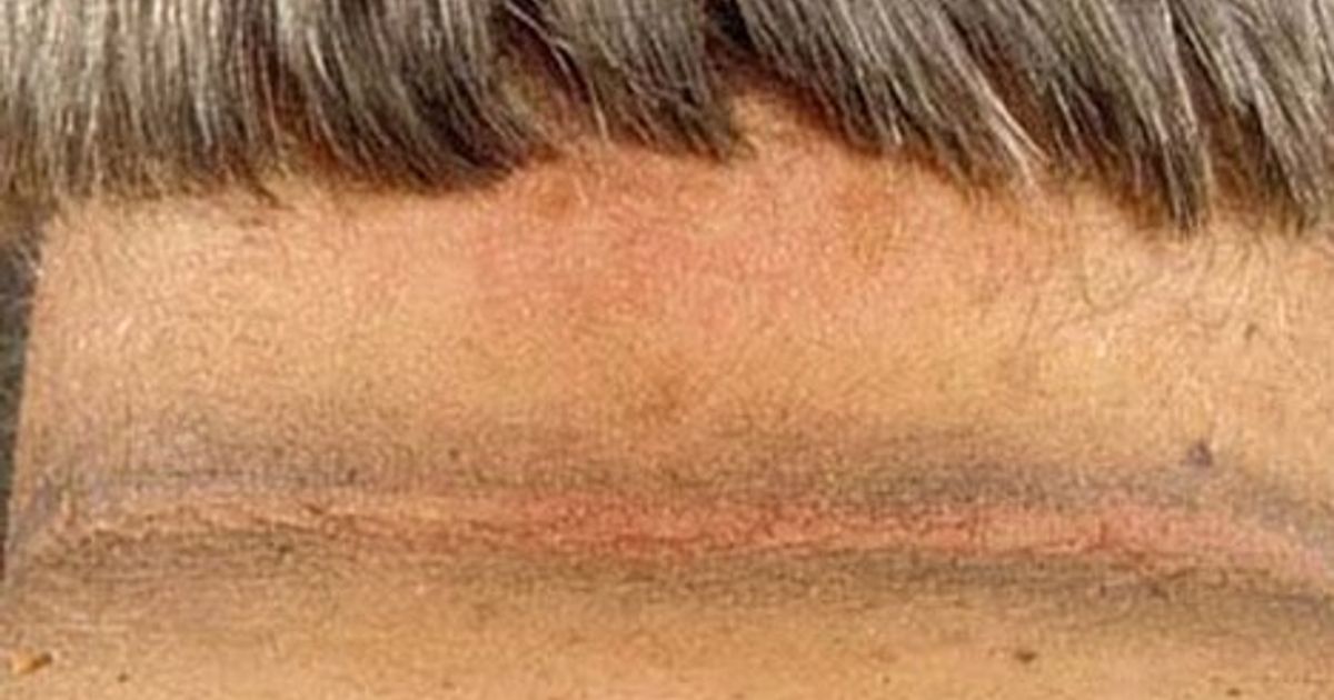 Black thorns .. a disease affects the skin may indicate more serious illnesses