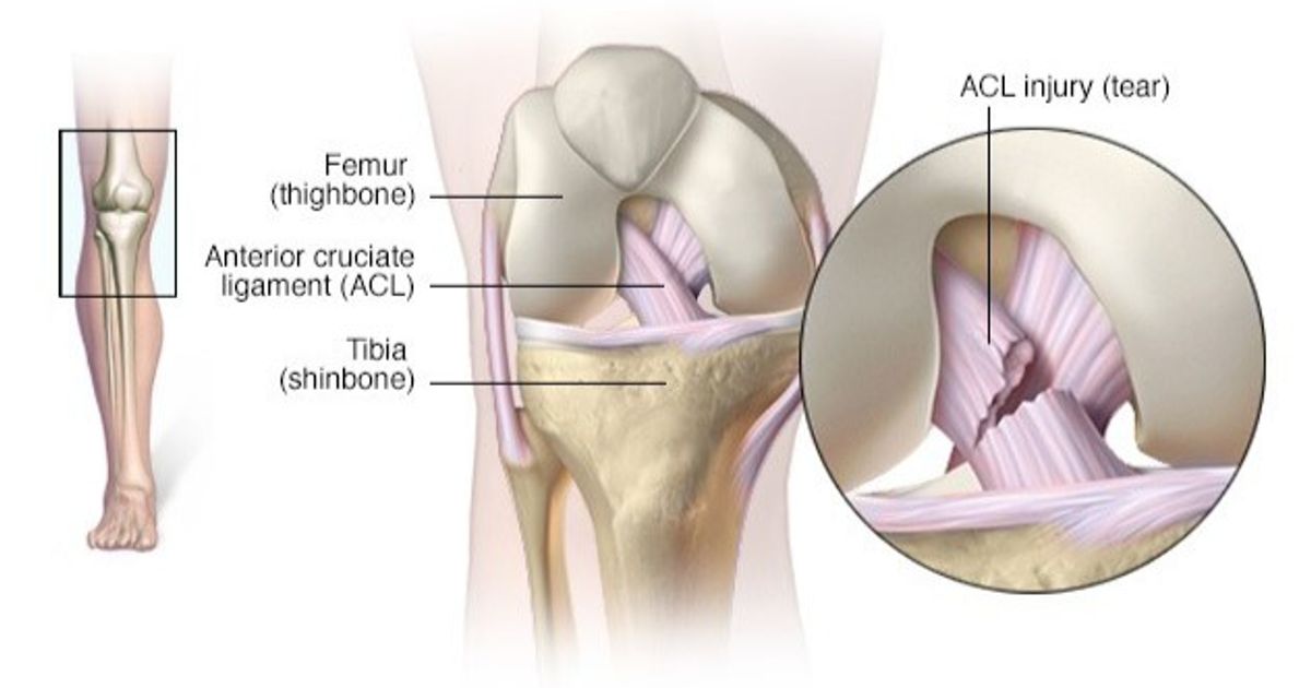 Leading Cruciate Ligament injury … your guide for diagnosis and treatment