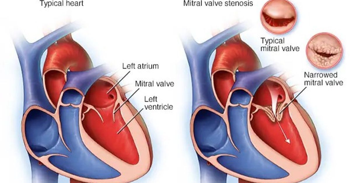 Heart disease .. methods to treat congenital deviations from the mitral valve