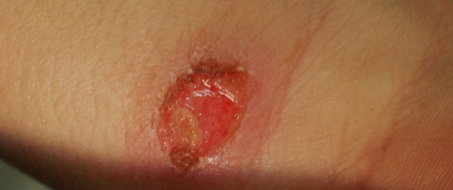 Lystmaniasis: Symptoms, Causes and Treatment
