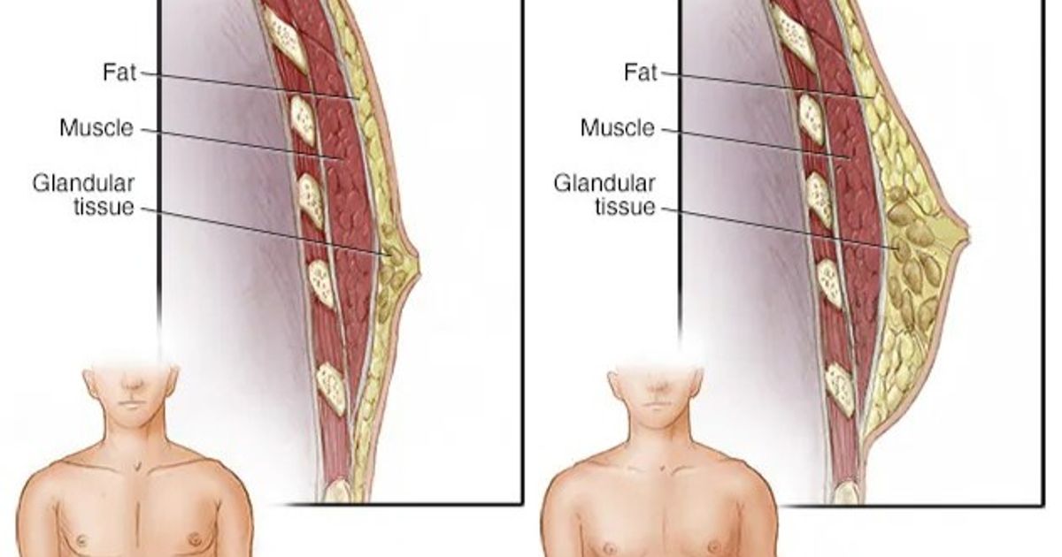 Gynecomasty in men … disturbing symptoms that can be eliminated easily