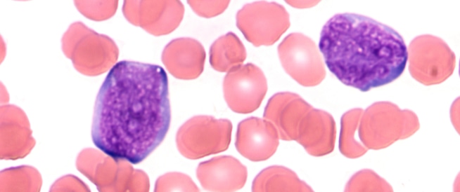 Acute Lymphs: Symptoms, Causes and Treatment