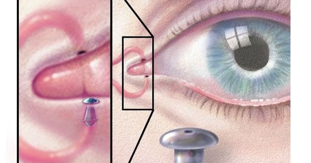 A new study explains the causes of dry eyes … and several tips for prevention