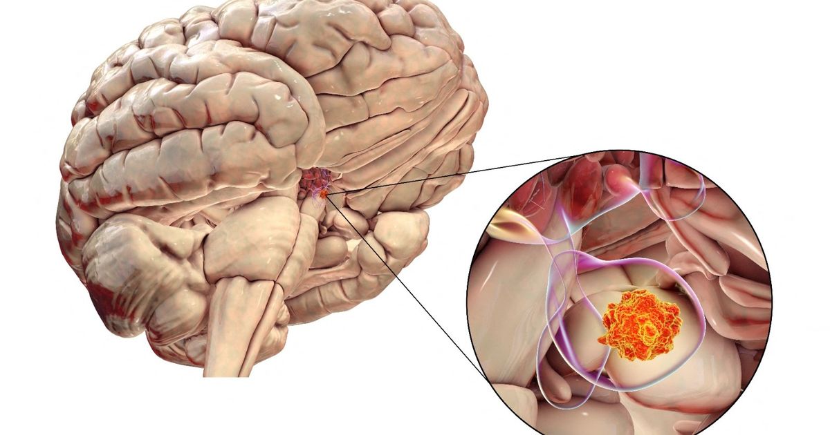 Optimism about finding a crop treatment affecting the brain stem after a child cures a rare cancer