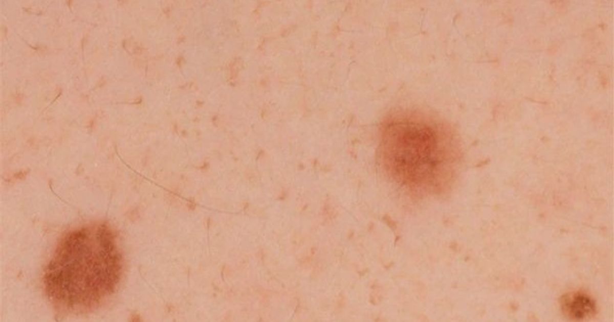 A rare type of skin cancer .. What are t -lymfocytes?