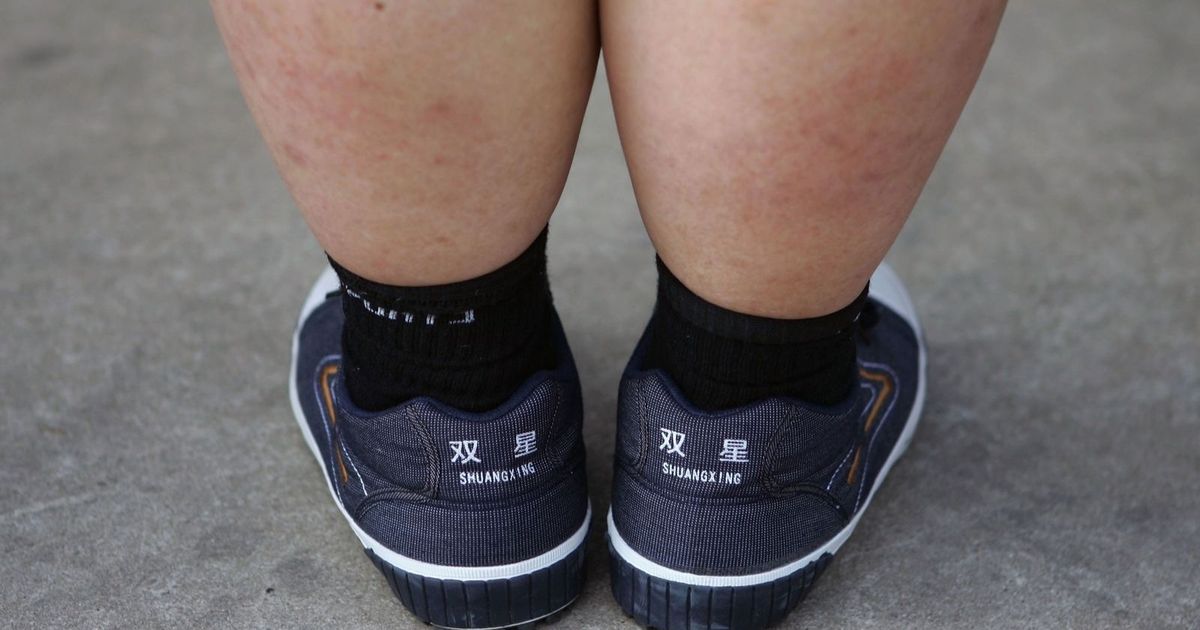 Obesity in children .. 5 methods of prevention