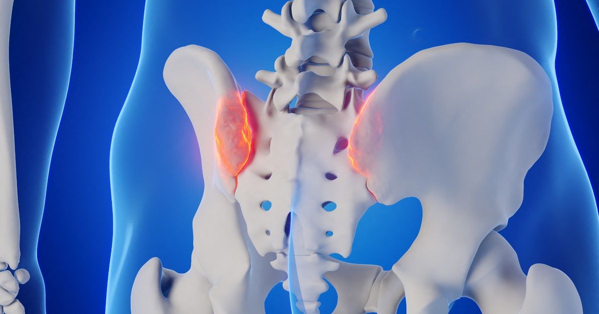 An inflammation of the iliac joint … symptoms, causes and treatment