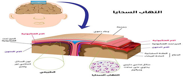 Menantitis: Causes, Symptoms and Treatment
