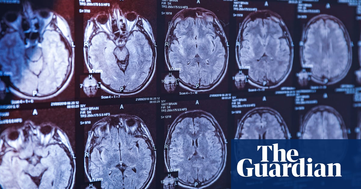Blood Test Could Detect Parkinson’s Disease Before Symptoms Emerge
