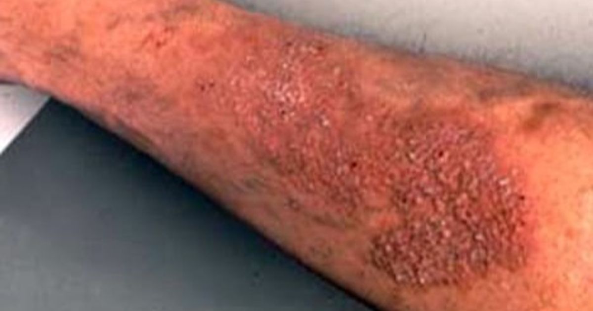 Nerve -learning inflammation .. a disease that starts with a place and affects the quality of life