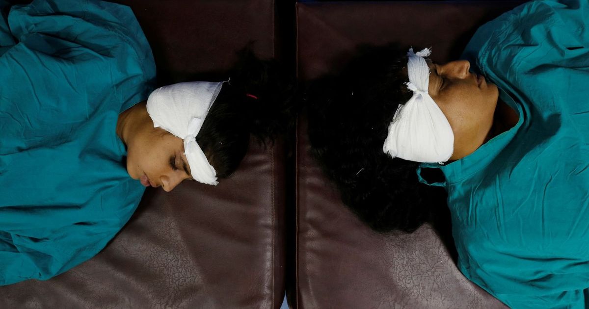 Over -tubes .. a surgical procedure to treat middle ear problems