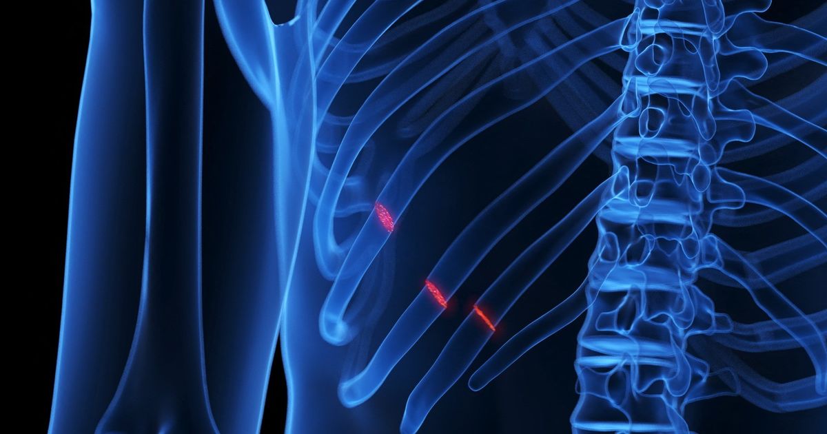 Fractures of ribs .. causes, symptoms and treatment