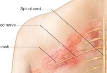 The fiery belt .. What is the herpes virus?