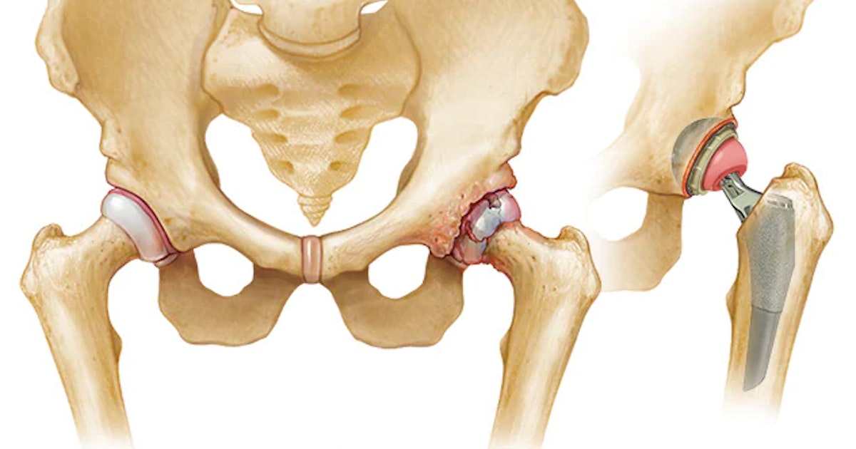 How do you prepare for a hip joint replacement process?