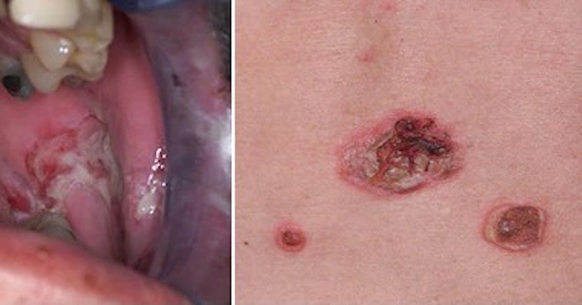 Defense .. causes, symptoms and complications