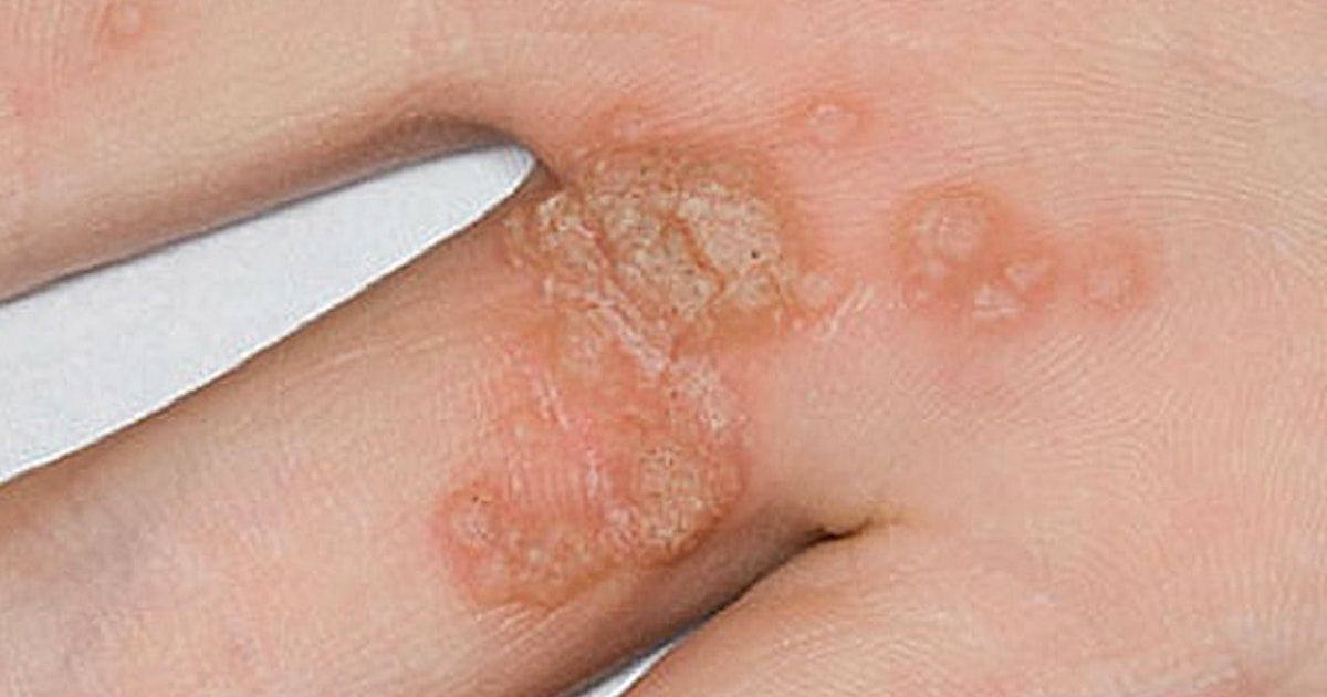 Common warts .. symptoms and prevention