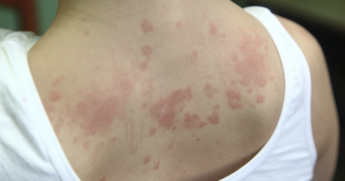 Allergy to nickel … diagnosis and treatment