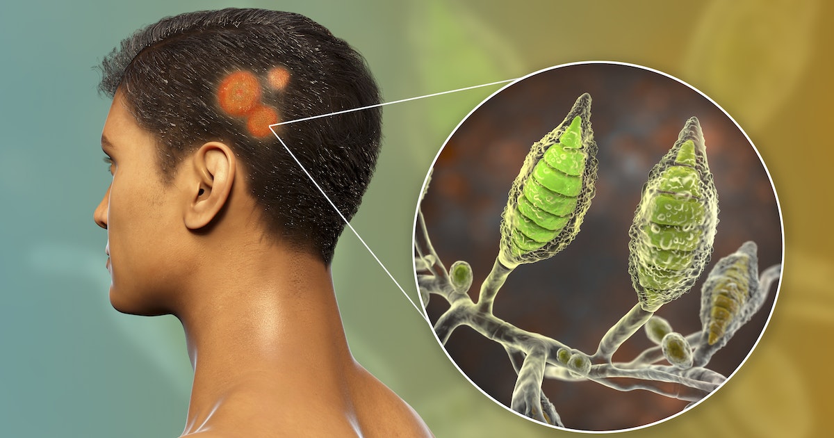 “Rest of the head” .. tips to avoid a fast -spread infection