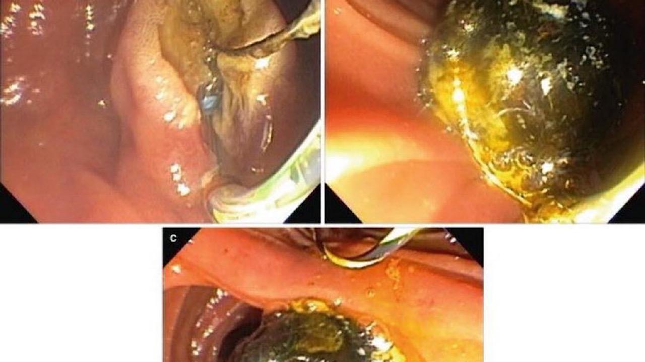 Grape channel stones are removed from the body – ryan