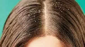 In winter, people have repeated repeated dandruff for these four reasons, know it today and avoid it
