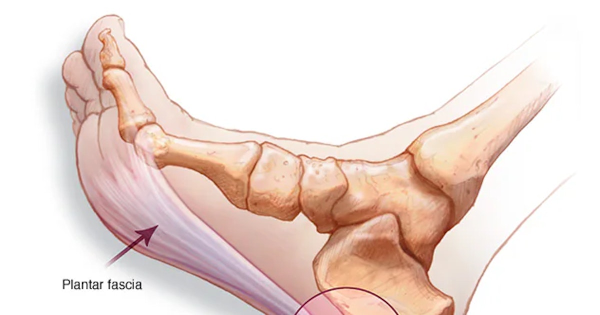 It occurs regularly among the enemies and those with excess weight. What is the plantar fasciitis?