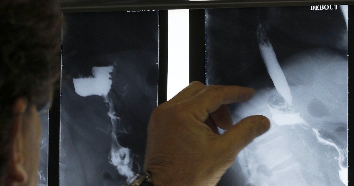 Study: Obesity reduces the risk of heart disease