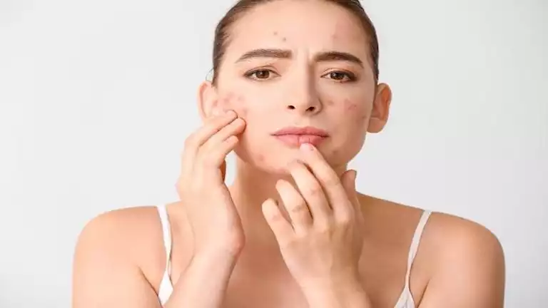 “Your skin Hatnour” .. 10 recipes from your kitchen get rid of acne – ryan