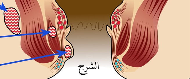 Anal abscess: causes, symptoms and treatment